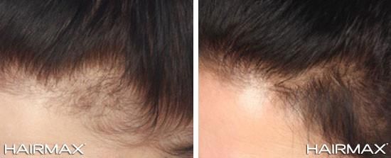 female before and after with hairmax