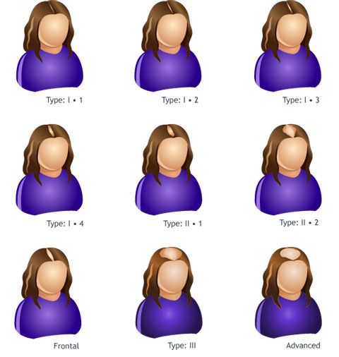 Female pattern hair loss
